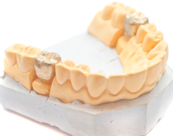Implantes dentales en Sant Boi Dr. Ruiz